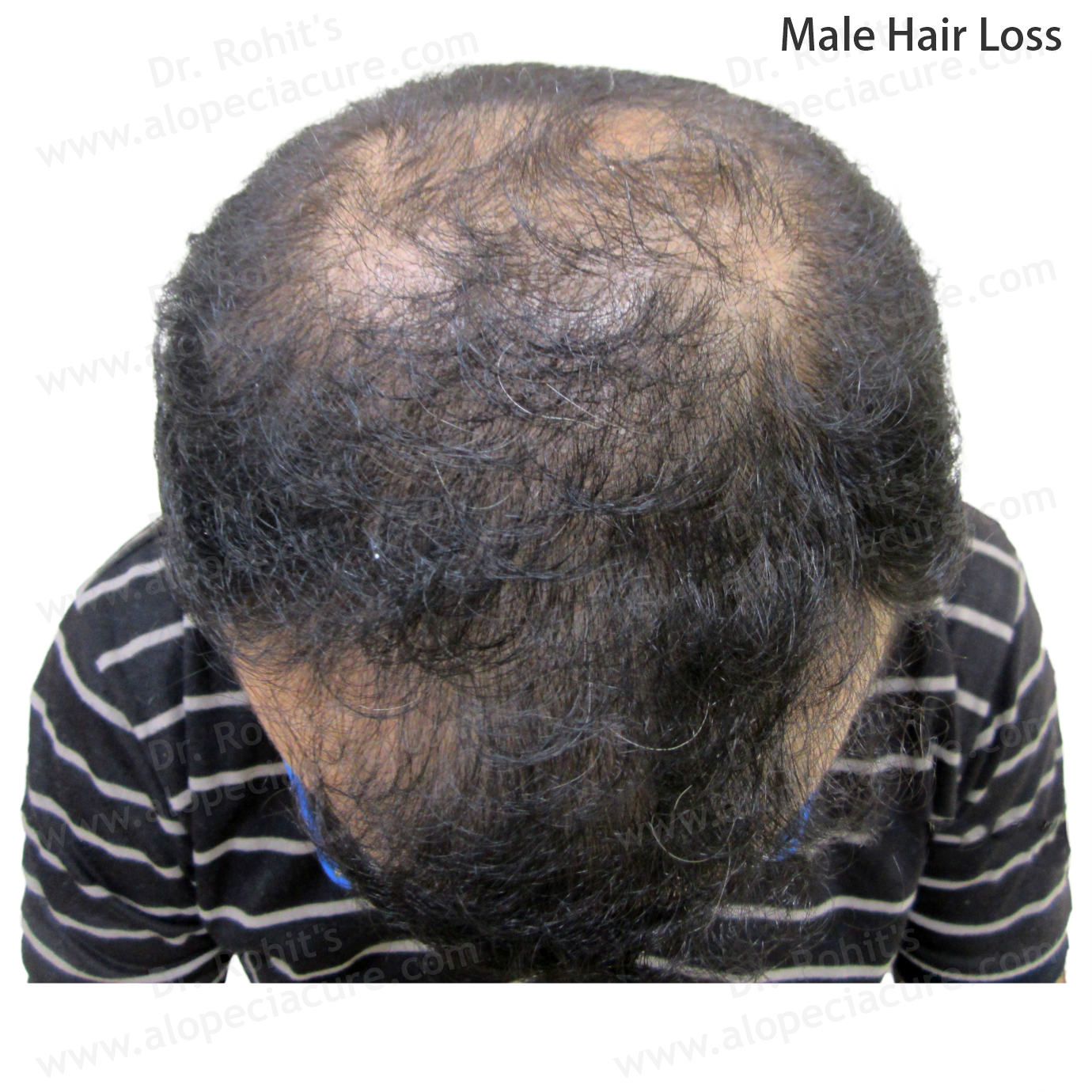Male Hair Loss Clinical Treatment